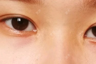 开内眼角
