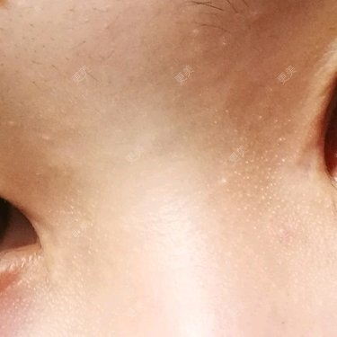 开内眼角