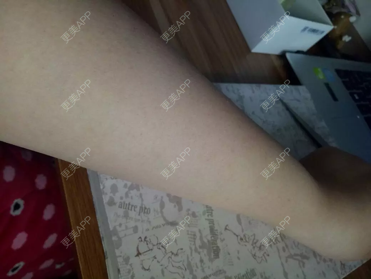 更美 - 微冷。的手臂脱毛经验 | 手臂脱毛 | 深圳