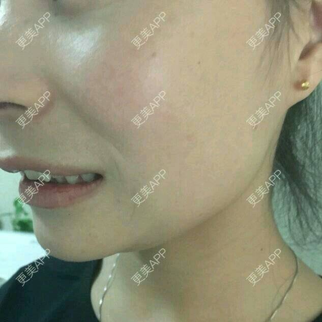 更美 - 爱美的尼雅的除皱瘦脸经验 | 除皱瘦脸 | 邯郸
