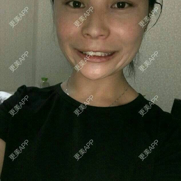 更美 - 爱美的尼雅的除皱瘦脸经验 | 除皱瘦脸 | 邯郸