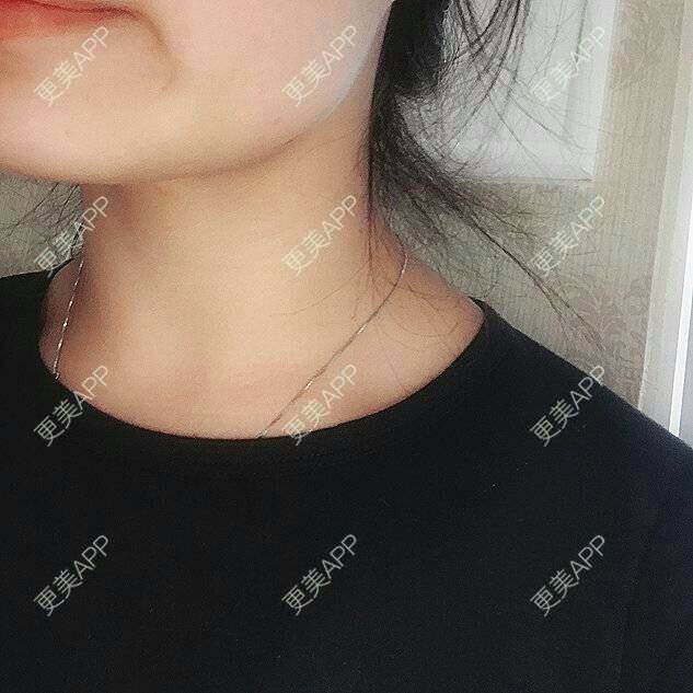 更美 - 爱美的尼雅的除皱瘦脸经验 | 除皱瘦脸 | 邯郸