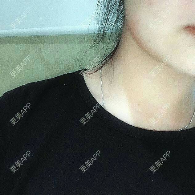 更美 - 爱美的尼雅的除皱瘦脸经验 | 除皱瘦脸 | 邯郸