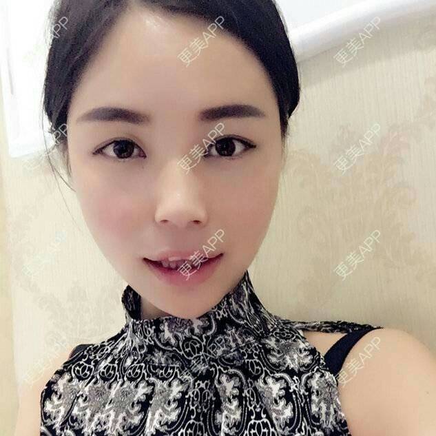 更美 - 爱美的尼雅的除皱瘦脸经验 | 除皱瘦脸 | 邯郸