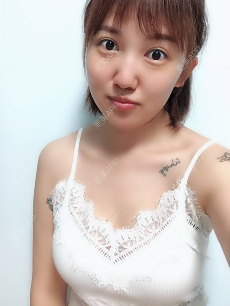 元气simple的自体脂肪隆胸日记