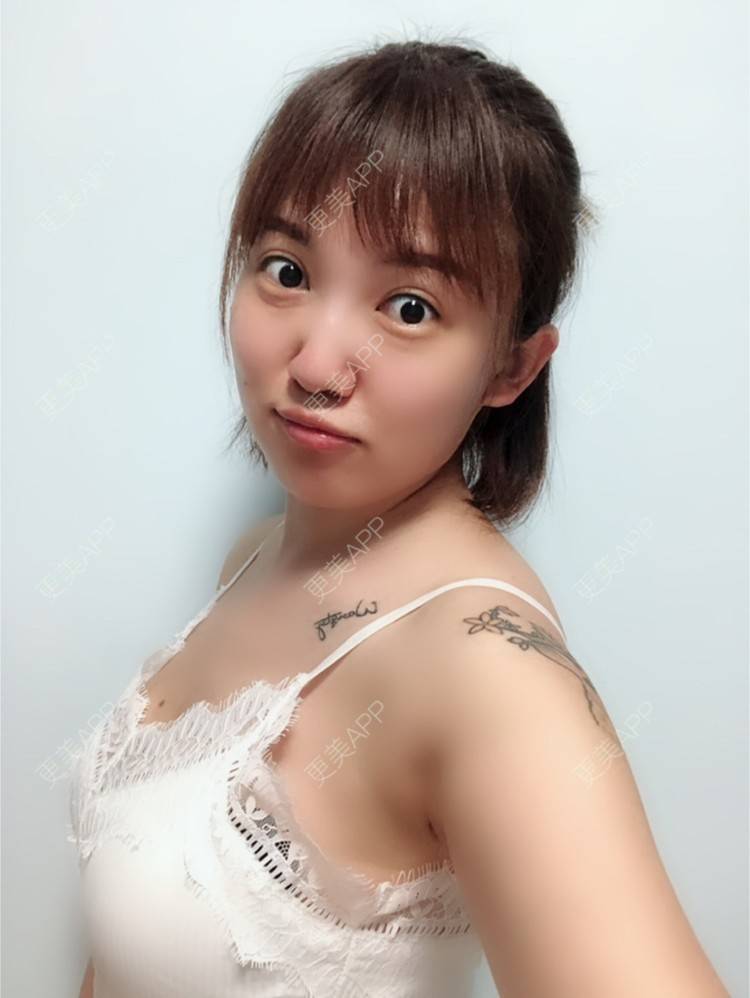 元气simple的自体脂肪隆胸日记