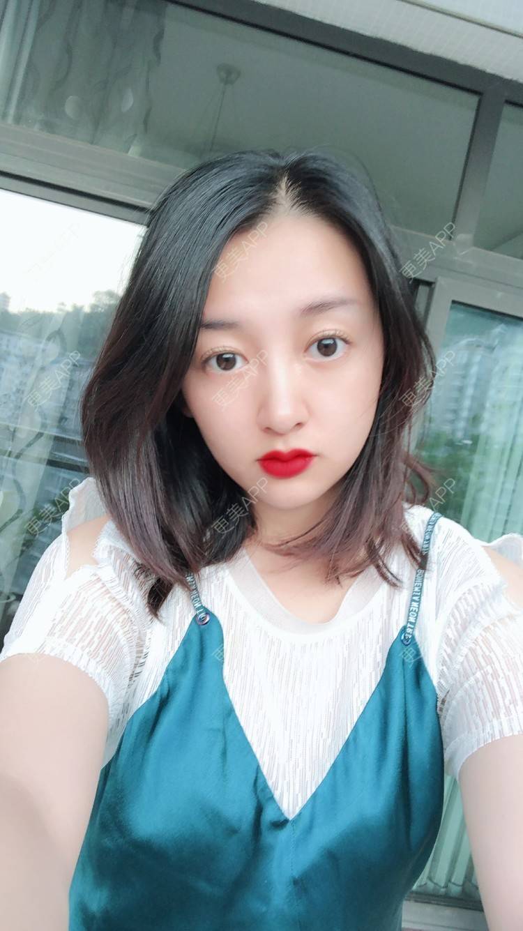 更美 - 更美用户COi6YHbVqT的宽下巴矫正经验 | 宽下巴矫正