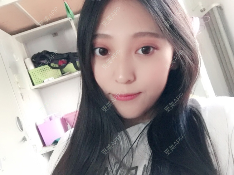 更美 - 于太阳的玻尿酸黑眼圈经验 | 玻尿酸黑眼圈