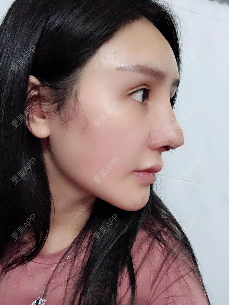 更美用户mzfpo53s6k的肋软骨隆鼻日记