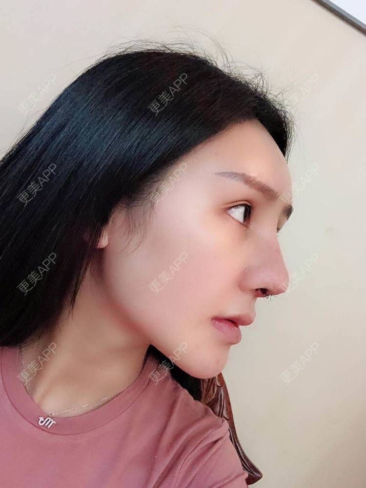 更美用户mzfpo53s6k的肋软骨隆鼻日记