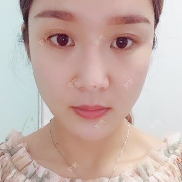 埋线提升
