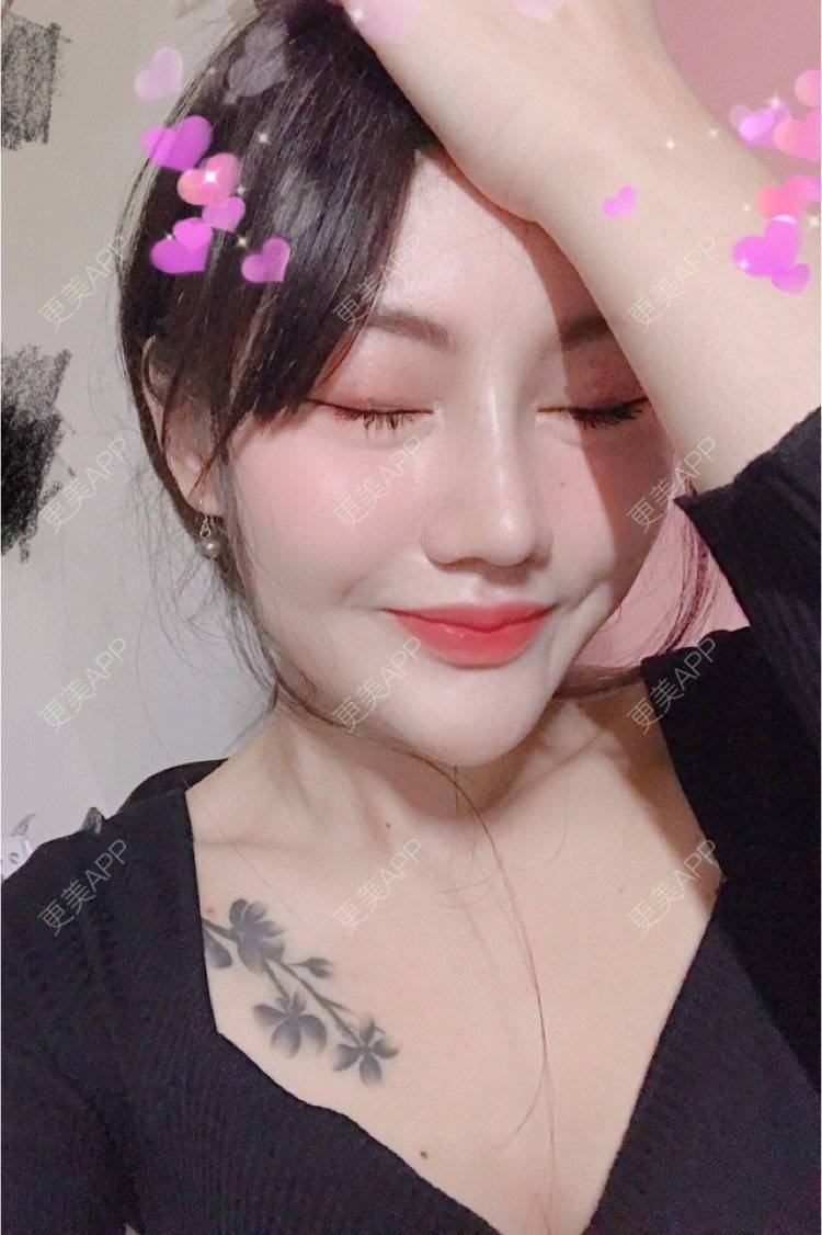 更美 - Kaleidoscope.的隆鼻经验 | 咸阳 | 隆鼻