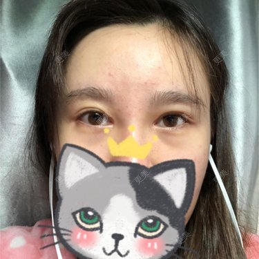 开内眼角