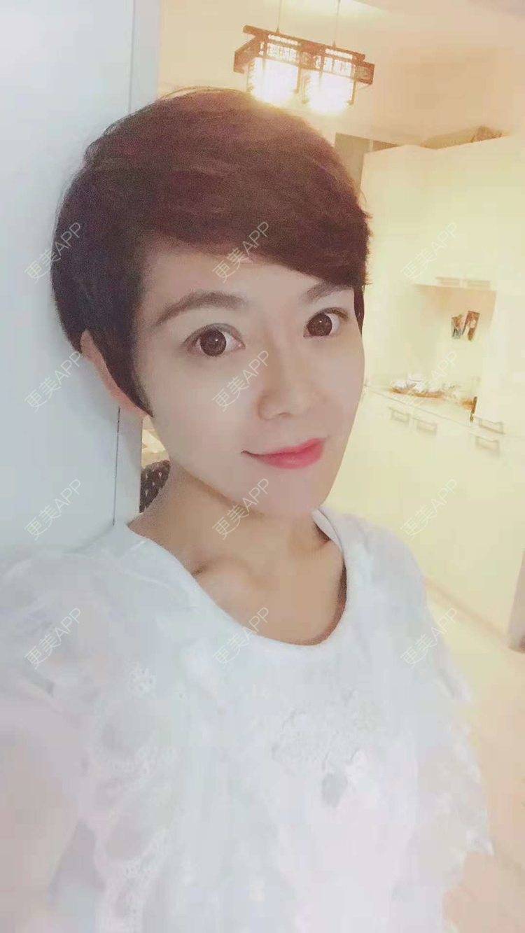 更美 - 鞍山铁东区张玉霞星范医疗美容门诊部的埋线隆鼻经验 | 埋线隆鼻