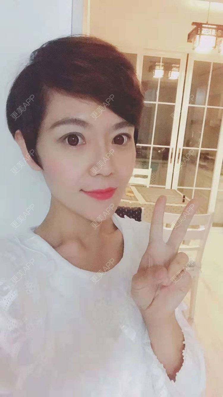 更美 - 鞍山铁东区张玉霞星范医疗美容门诊部的埋线隆鼻经验 | 埋线隆鼻