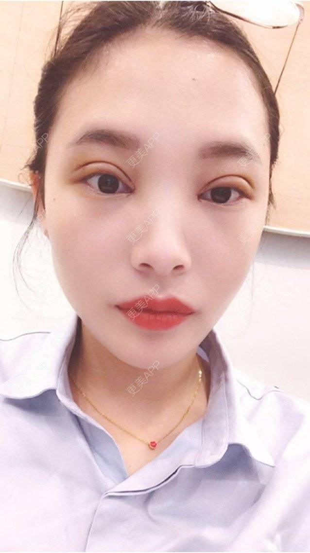 更美用户koiddfv100的全切双眼皮日记