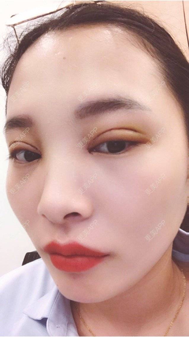 全切双眼皮图片_更美用户koiddfv100全切双眼皮图片_术后2天__更美