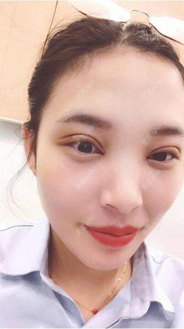 更美用户koiddfv100的全切双眼皮日记