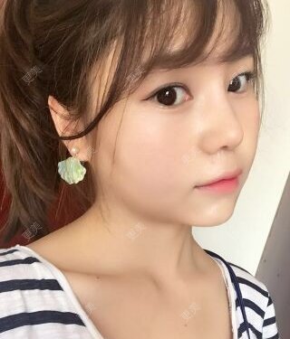 自体脂肪隆鼻