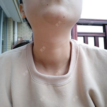 玻尿酸溶解酶