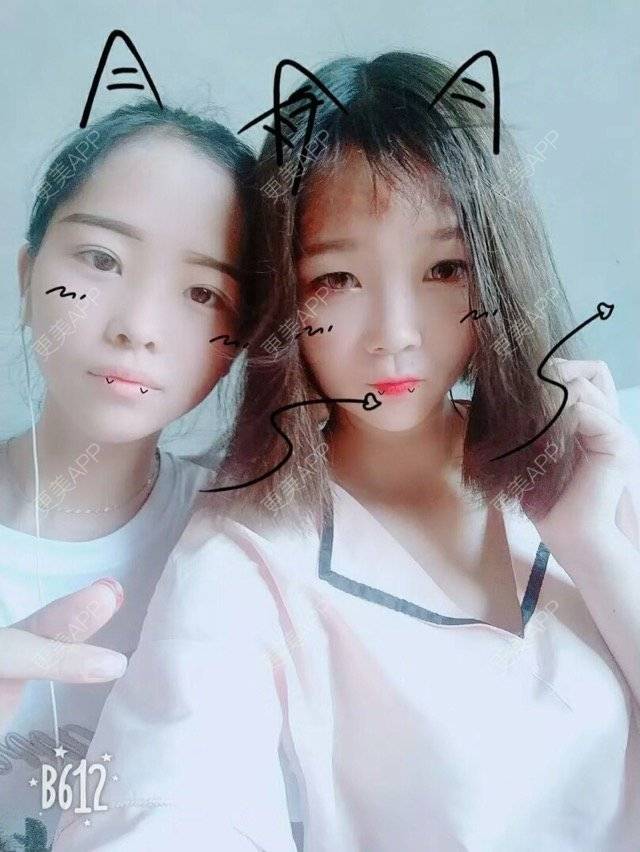 更美 - 嘻嘻图二八的乳晕缩小经验 | 乳晕缩小 | 胸部塑身