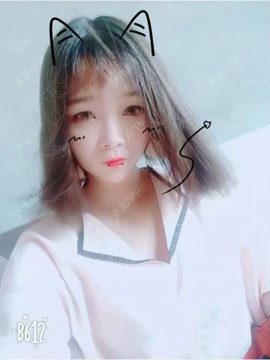 更美 - 嘻嘻图二八的乳晕缩小经验 | 乳晕缩小 | 胸部塑身