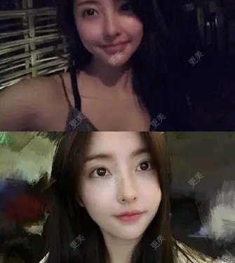 自体脂肪垫下巴