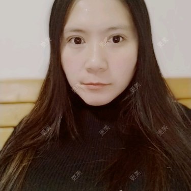 自体脂肪垫下巴
