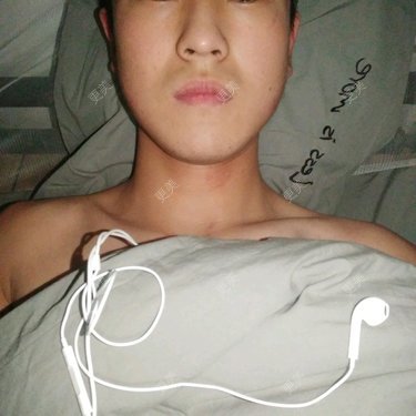 面部不对称矫正