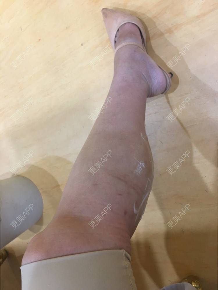 更美 - miumiu-C的注射塑形腿部经验 | 深圳 | 西安 | 假体丰臀 | 北京 | 杭州 | 佛山 | 注射塑形腿部 | 吸脂 | 牙齿美白 | 隆鼻 | 武汉 | 广州 | 女性私密 | 洗牙