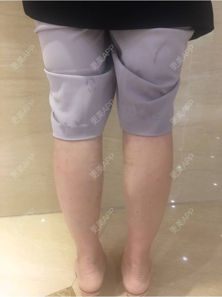 更美 - miumiu-C的注射塑形腿部经验 | 深圳 | 西安 | 假体丰臀 | 北京 | 杭州 | 佛山 | 注射塑形腿部 | 吸脂 | 牙齿美白 | 隆鼻 | 武汉 | 广州 | 女性私密 | 洗牙