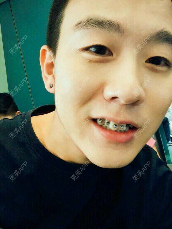 更美 - 酒窝上的奶油呐的经验 | 植胡须 | 隆鼻 | 玻尿酸溶解酶 | 种植牙 | 北京