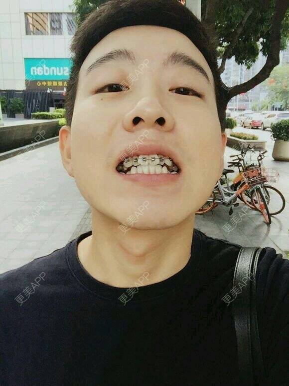 更美 - 酒窝上的奶油呐的经验 | 植胡须 | 隆鼻 | 玻尿酸溶解酶 | 种植牙 | 北京