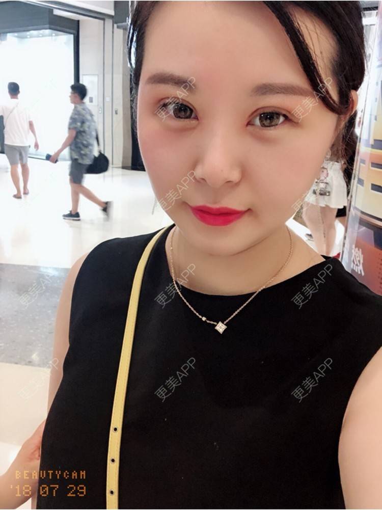 更美 - 更美用户4y2GBve8x9的眼部综合经验 | 眼部修复 | 眼部综合 | 武汉 | 北京 | 水光项目 | 佛山 | 膨体丰额头 | 鼻部多项 | 毛发移植 | 广州 | 常州 | 深圳 | 自体脂肪丰臀 | 西安 | 郑州 | 杭州 | 光纤溶脂 | 大连 | 埋线提升 | 自体脂肪隆胸 | 牙齿美白 | 除皱瘦脸 | 吸脂瘦脸 | 美容冠 | PRP自体血清美肤 | 女性私密