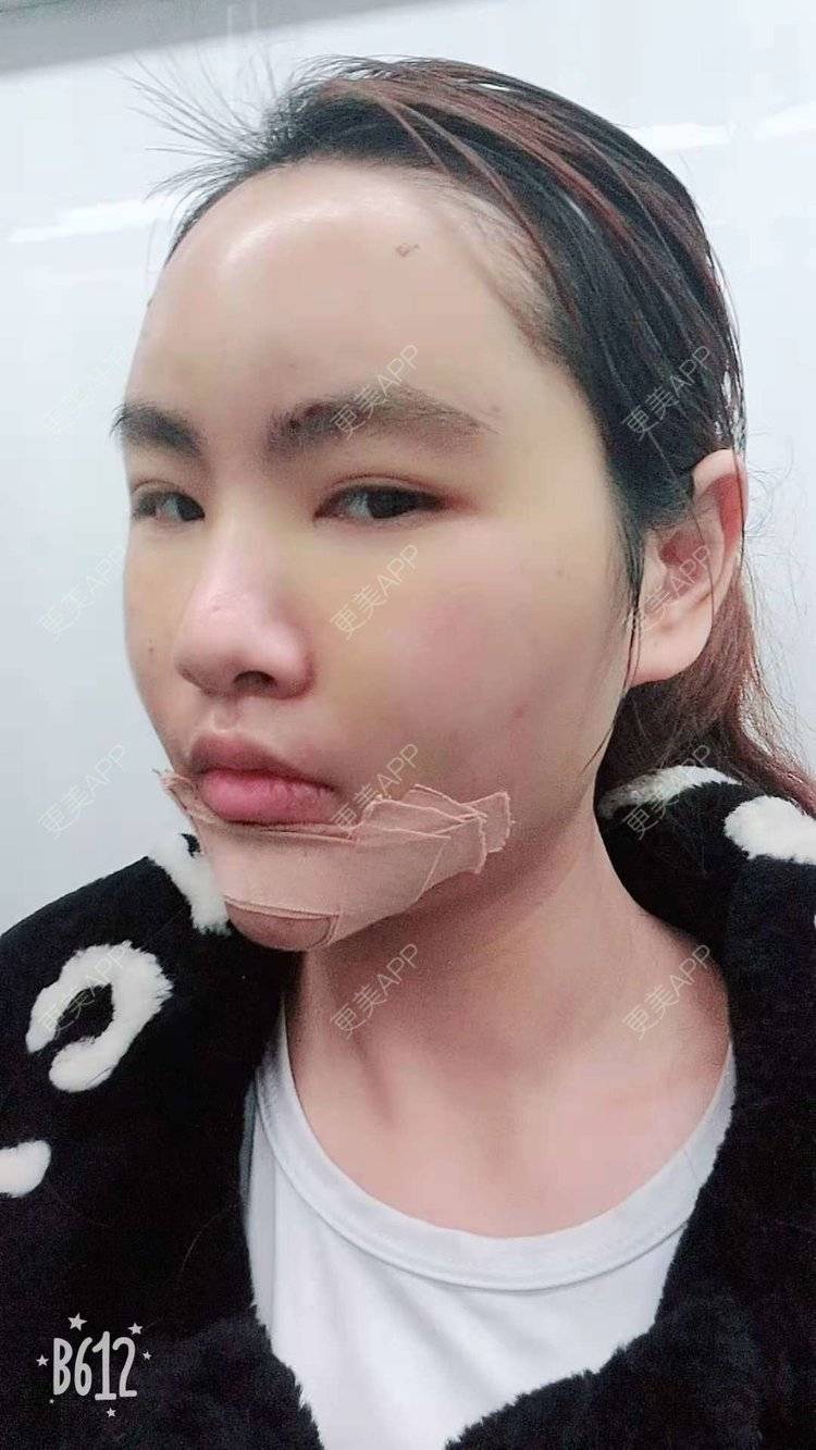 更美 - （摩天大楼）的玻尿酸面部细纹经验 | 玻尿酸面部细纹 | 更美研究所 | 杭州 | 下巴