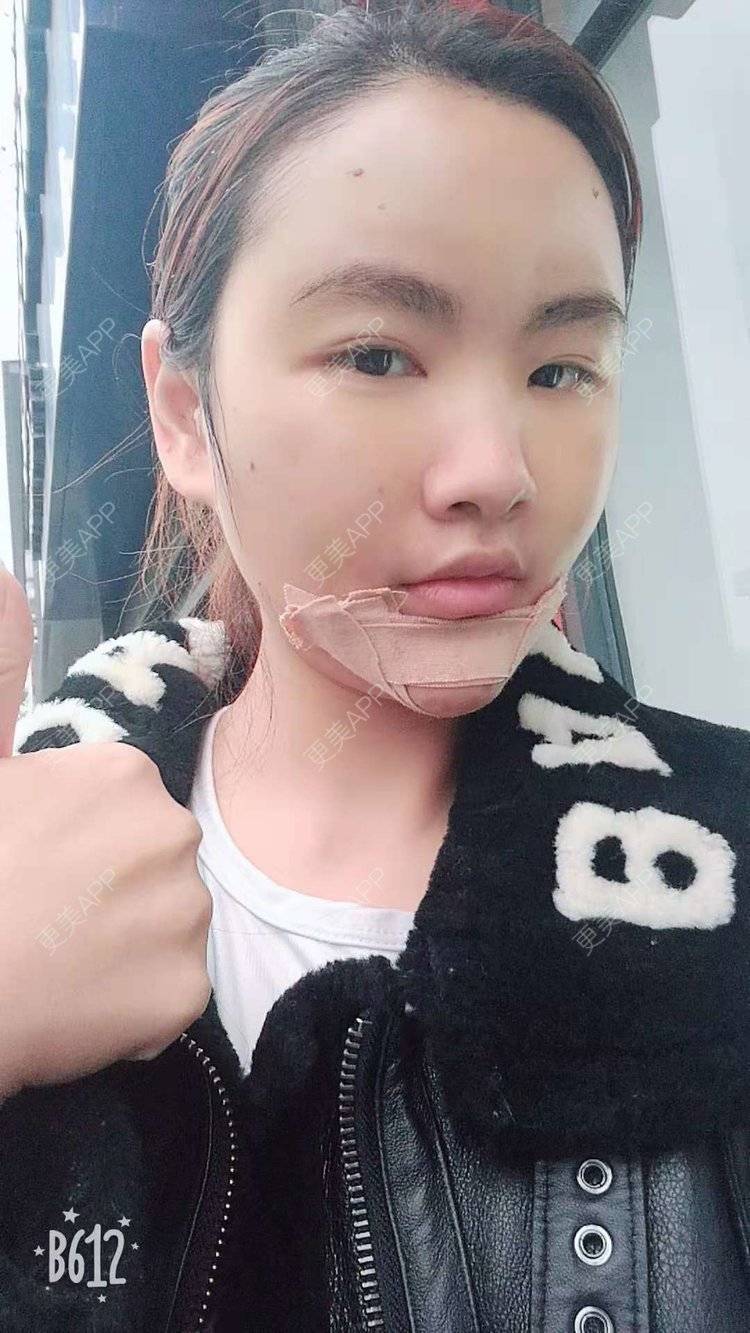 更美 - （摩天大楼）的玻尿酸面部细纹经验 | 玻尿酸面部细纹 | 更美研究所 | 杭州 | 下巴