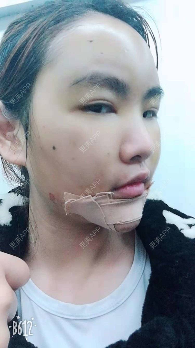 更美 - （摩天大楼）的玻尿酸面部细纹经验 | 玻尿酸面部细纹 | 更美研究所 | 杭州 | 下巴