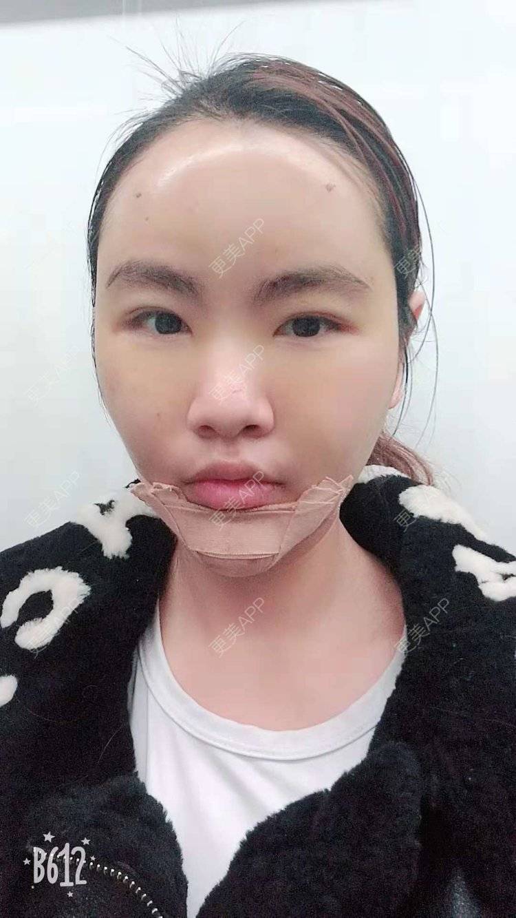 更美 - （摩天大楼）的玻尿酸面部细纹经验 | 玻尿酸面部细纹 | 更美研究所 | 杭州 | 下巴
