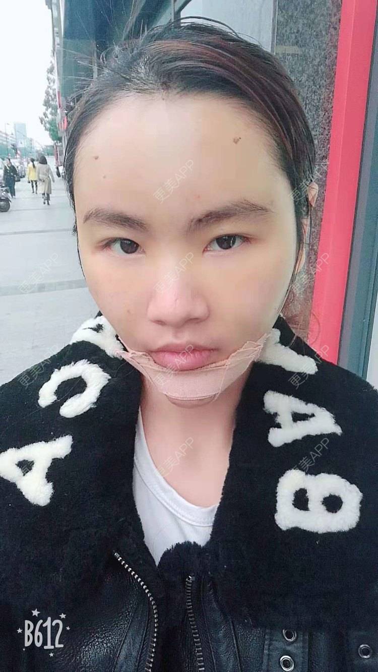 更美 - （摩天大楼）的玻尿酸面部细纹经验 | 玻尿酸面部细纹 | 更美研究所 | 杭州 | 下巴