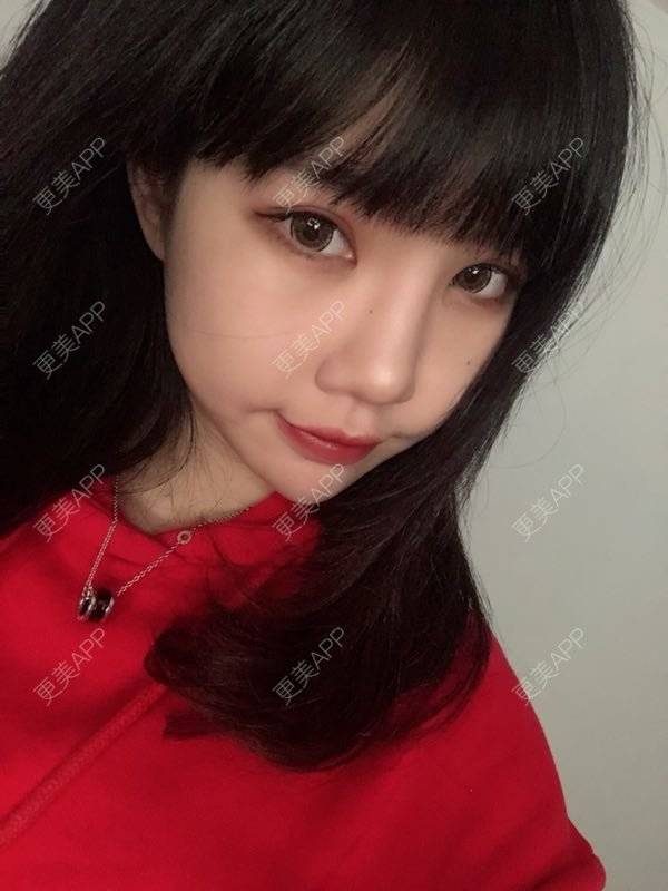 更美 - 龙喵ɑ^0^的膨体垫下巴经验 | 南宁 | 膨体垫下巴