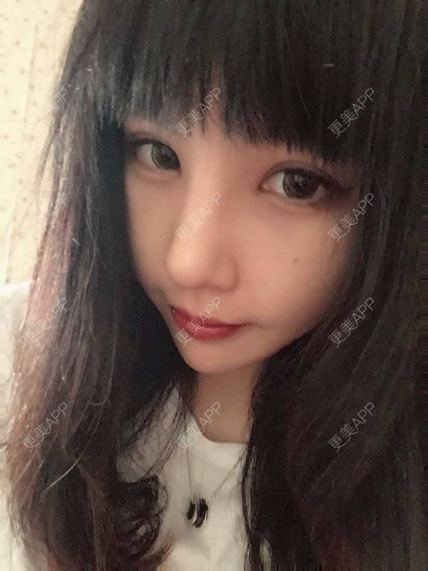 更美 - 龙喵ɑ^0^的膨体垫下巴经验 | 南宁 | 膨体垫下巴