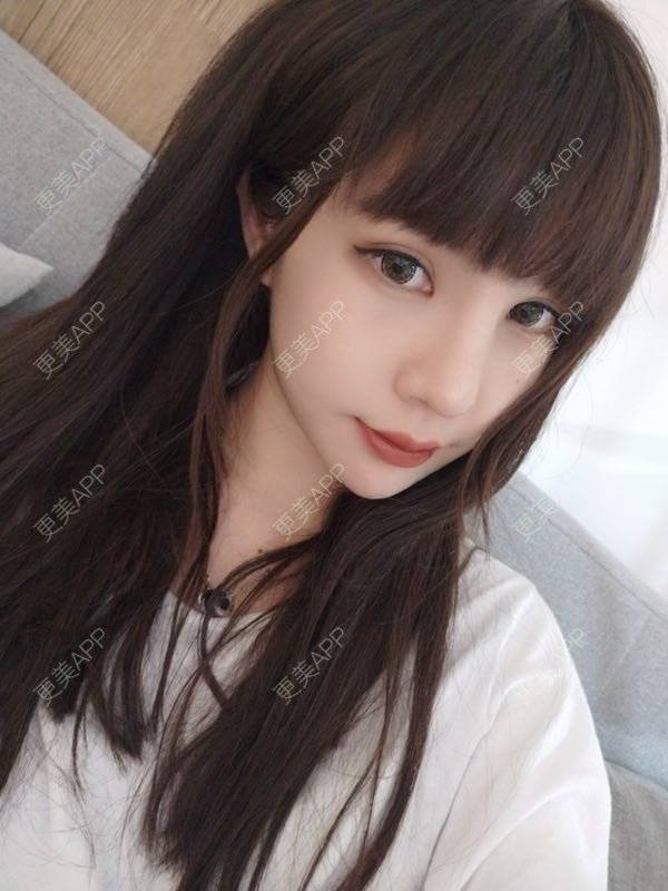 更美 - 龙喵ɑ^0^的膨体垫下巴经验 | 南宁 | 膨体垫下巴