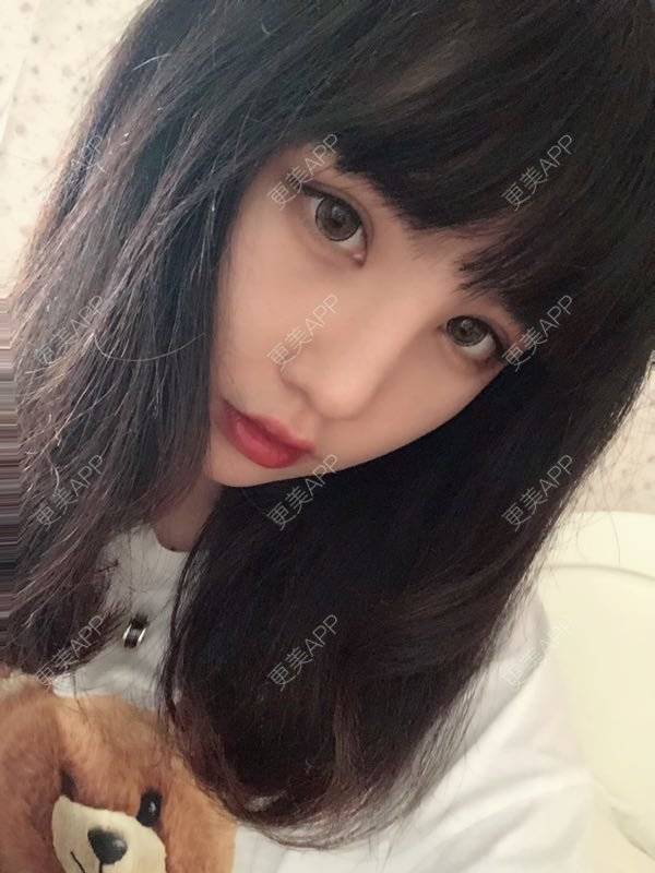 更美 - 龙喵ɑ^0^的膨体垫下巴经验 | 南宁 | 膨体垫下巴