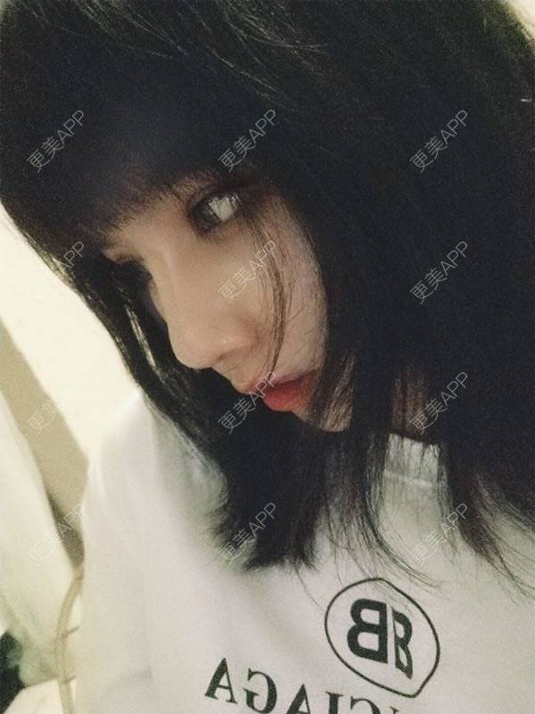 更美 - 龙喵ɑ^0^的膨体垫下巴经验 | 南宁 | 膨体垫下巴