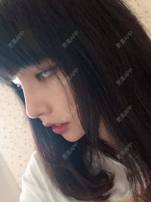 更美 - 龙喵ɑ^0^的膨体垫下巴经验 | 南宁 | 膨体垫下巴