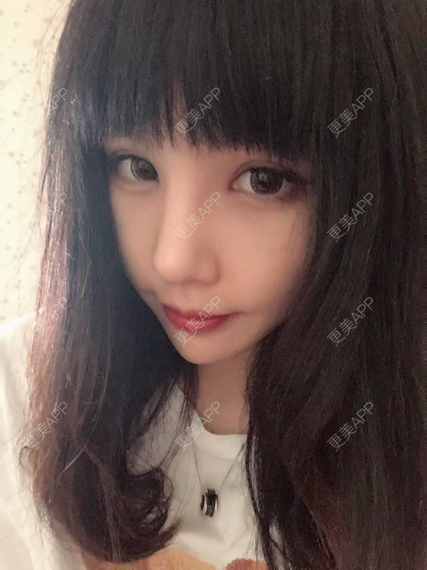 更美 - 龙喵ɑ^0^的膨体垫下巴经验 | 南宁 | 膨体垫下巴