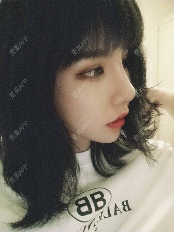 更美 - 龙喵ɑ^0^的膨体垫下巴经验 | 南宁 | 膨体垫下巴