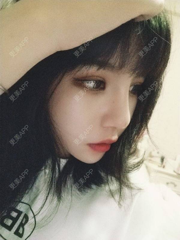 更美 - 龙喵ɑ^0^的膨体垫下巴经验 | 南宁 | 膨体垫下巴