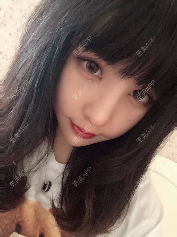 更美 - 龙喵ɑ^0^的膨体垫下巴经验 | 南宁 | 膨体垫下巴