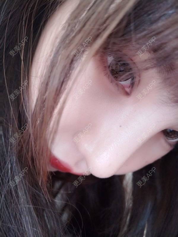 更美 - 龙喵ɑ^0^的膨体垫下巴经验 | 南宁 | 膨体垫下巴